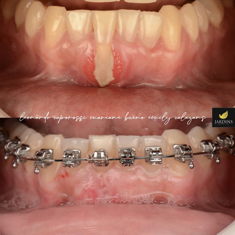 Antes e depois: enxerto de gengiva em paciente ortodôntico