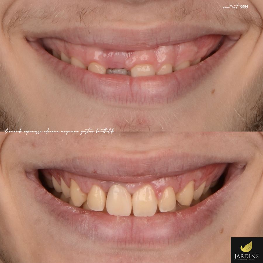 Antes e depois: implante em incisivo central superior