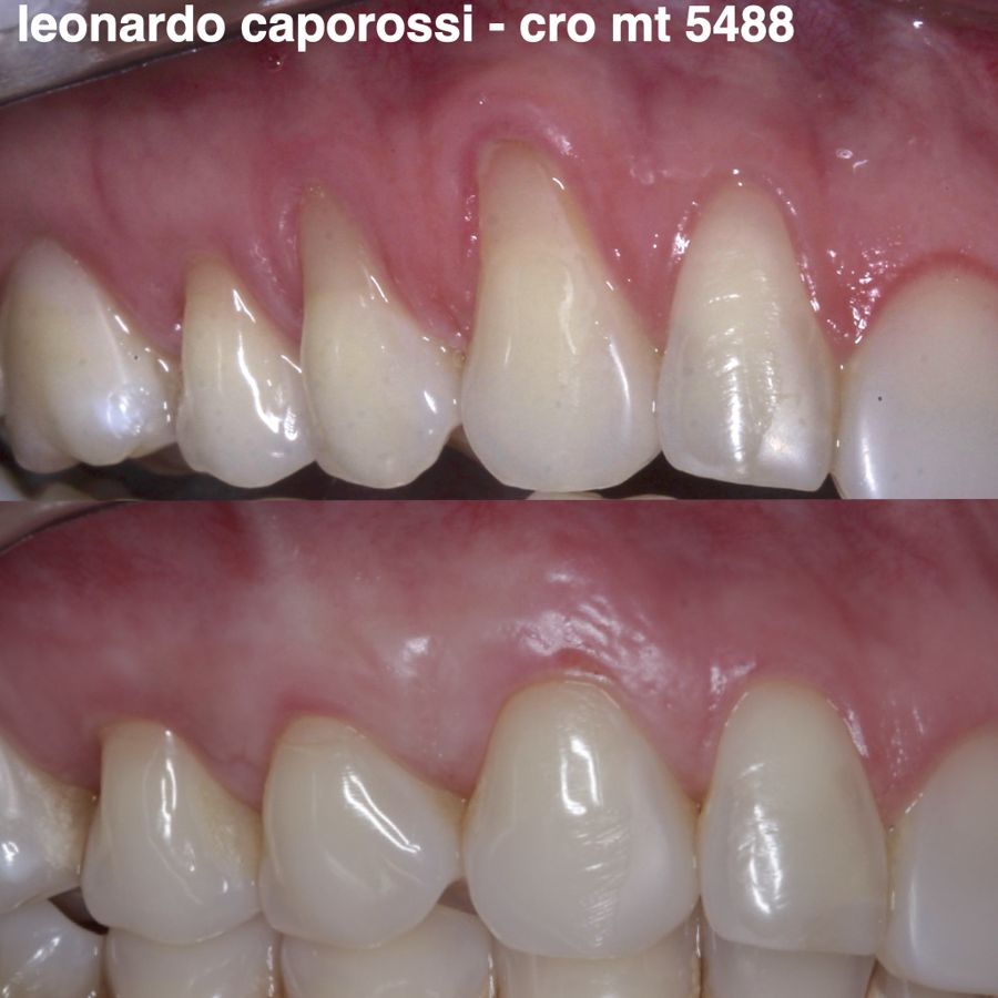 Antes e depois: retrações em vários dentes superiores